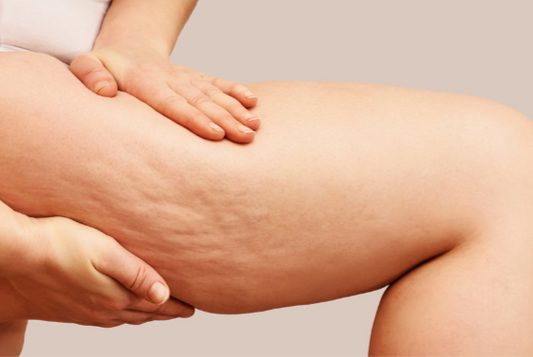 Can Light Therapy Help with Cellulite?